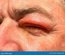 Image result for Molluscum Contagiosum On Eyelid