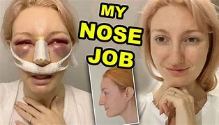 Image result for Nose Job Recovery