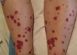 Image result for Lupus Skin Rashes On Legs
