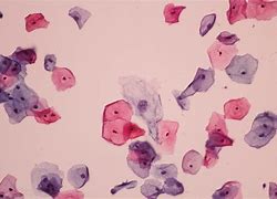 Image result for Squamous Cell Carcinoma Cervical Cancer