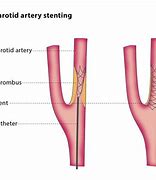 Image result for Carotid Artery Stent Placement