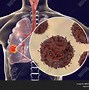 Image result for Adenocarcinoma in Situ Lung