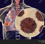Image result for Lung Cancer Tumor