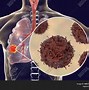 Image result for 9 Cm Tumor in Lung
