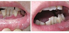 Image result for Gingival Mucosa