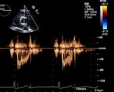 Image result for 2D Echocardiogram