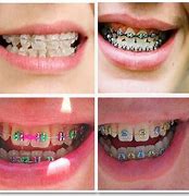 Image result for How to Make Fake Braces for Teeth