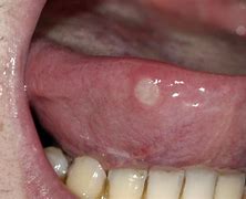 Image result for Mouth Ulcer