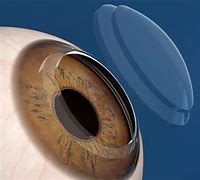 Image result for Eye Cornea Transplant