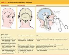 Image result for Cranial Repair for Encefalocel