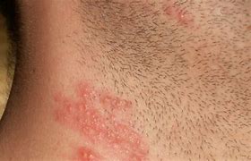 Image result for Allergic Rash On Neck