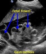 Image result for Gastroschisis Fetal Ultrasound