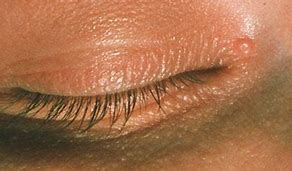 Image result for Molluscum Contagiosum Eye