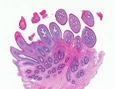 Image result for Tongue Papilloma