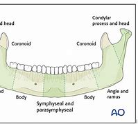 Image result for Types of Jaw Fractures