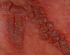 Image result for Genital Warts Symptoms Disease