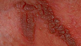 Image result for Genital Wart Risk Factors