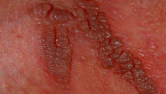Image result for Female Genital Warts Mild Case