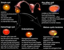 Image result for Ovarian Cyst Size Chart