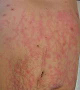 Image result for Erythema