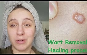 Image result for Filiform Wart Removal