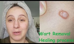 Image result for Wart to Back of Leg Cryotherapy