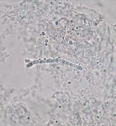 Image result for Molluscum Contagiosum White Core