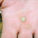Image result for Lotus Seed Pod Skin Disease