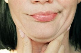 Image result for Double Chin or Goiter