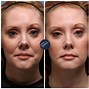Image result for Marionette Lines Before and After Botox