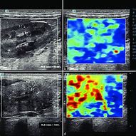 Image result for B-mode Ultrasound