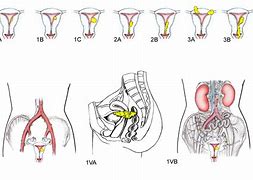 Image result for Endometrial Cancer Staging
