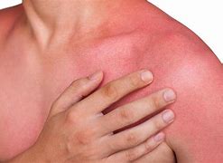 Image result for Blood Dots On Skin From Sun Burn