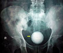 Image result for Bladder Tumor X-ray