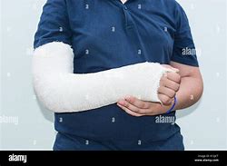 Image result for Broken Arm Plaster Cast