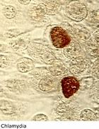 Image result for Chlamydia Patient