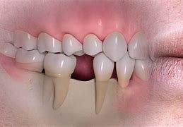 Image result for Jawbone Deterioration and Ripping