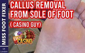 Image result for Foot Callus Removal Surgery