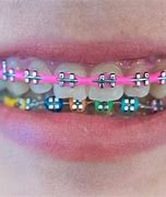 Image result for Cool Braces Ideas