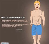 Image result for acondropl�sicp