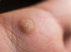 Image result for Flat Warts vs Molluscum