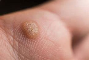 Image result for Warts or Molluscum