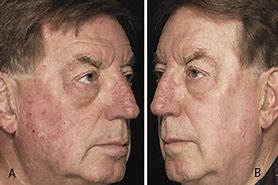 Image result for Actinic Keratosis Treatment On Face