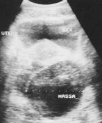 Image result for Right Adnexal Cyst