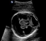 Image result for Ultrasound Images of Semilobar Holoprosencephaly