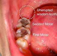 Image result for Abscess Wisdom Tooth Extraction