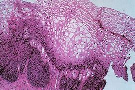Image result for Cervical Condyloma