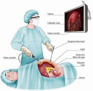 Image result for Robotic Cystectomy