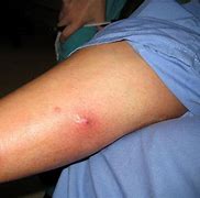 Image result for Human Bot Fly Infection