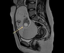 Image result for Dermoid Cyst MRI